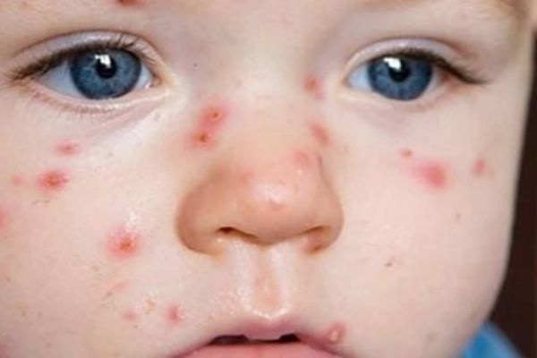 Mezi předškoláky v Plzni řádí plané neštovice