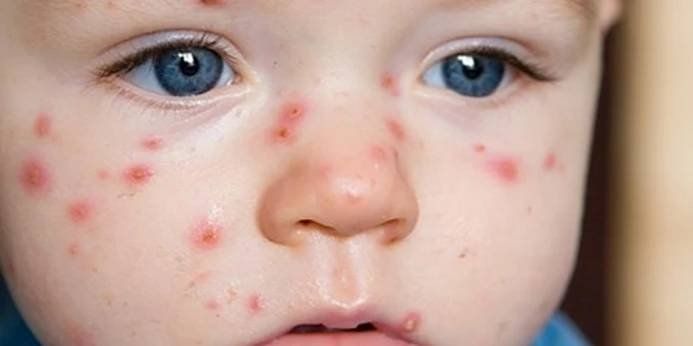 Mezi předškoláky v Plzni řádí plané neštovice